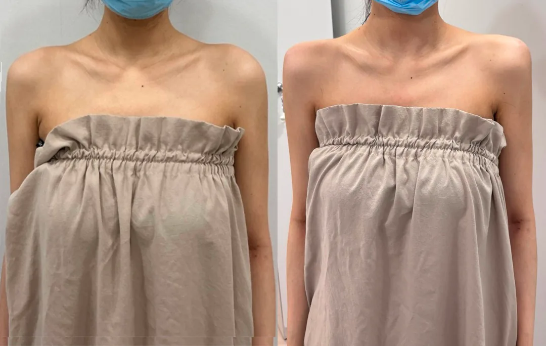 상체·어깨 라인 비포 애프터 사진