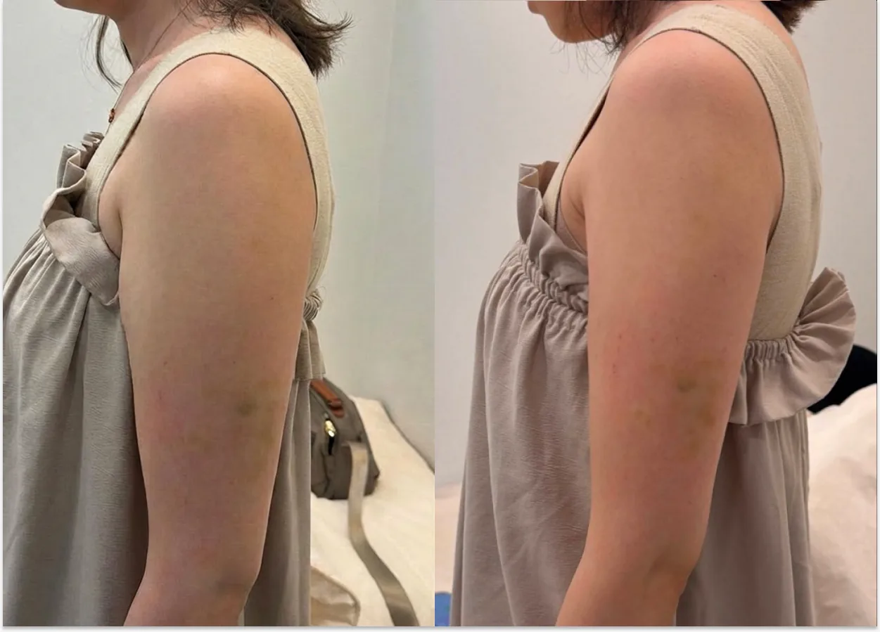 팔뚝 측면 라인 비포 애프터 사진