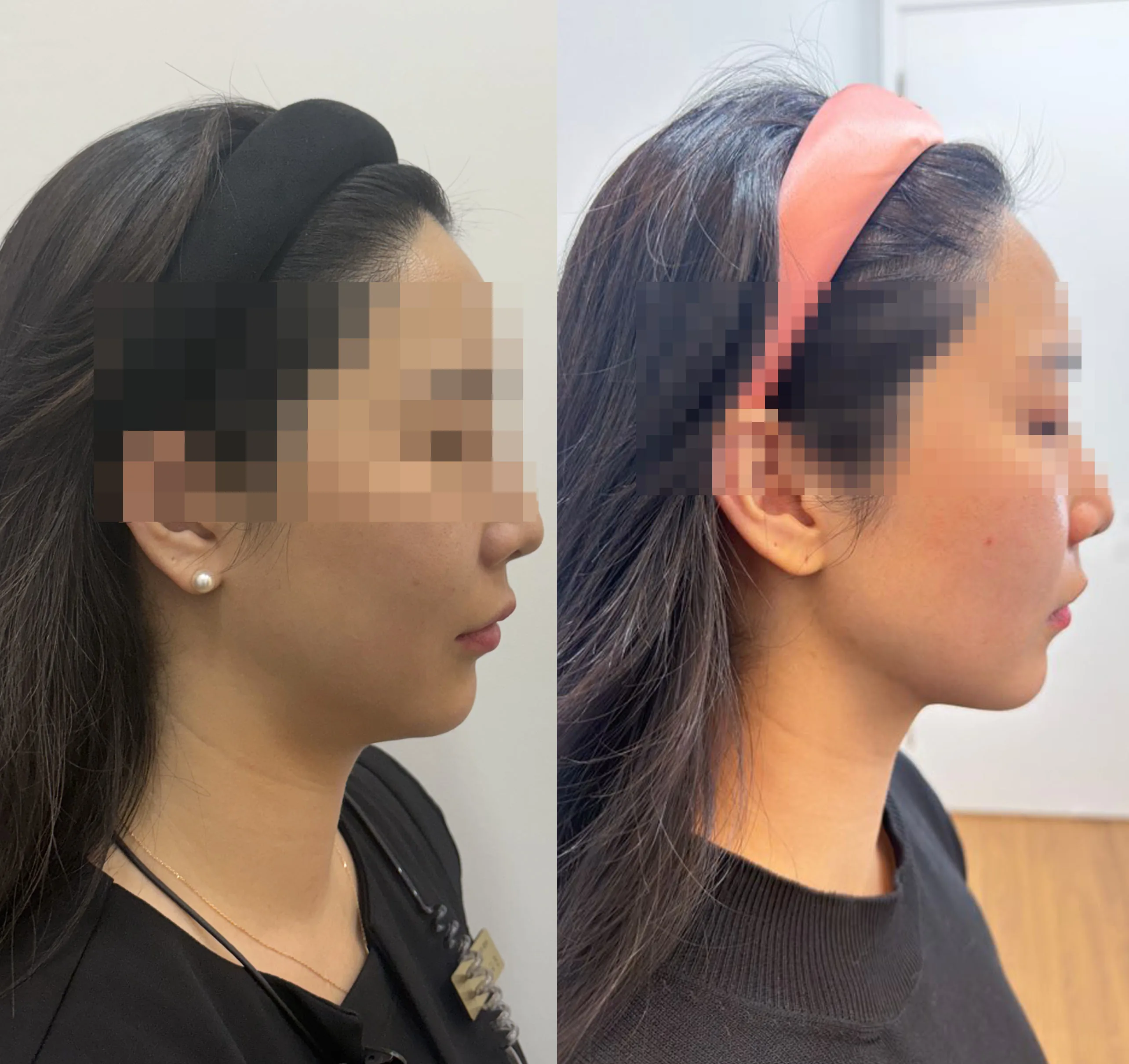턱선 V라인 리프팅 비포 애프터 사진
